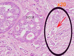 Low and medium power views of intermediate grade DCIS with adjacent invasion (circled).